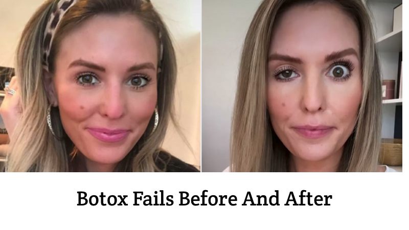 Botox Brow Lift Gone Wrong